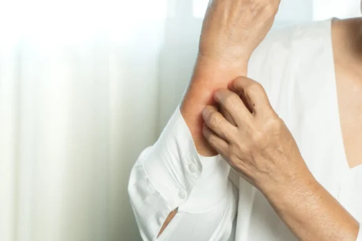 Scabbia, che cos’è la malattia infettiva per cui sono in quarantena 80 anziani ricoverati a Settimo Torinese